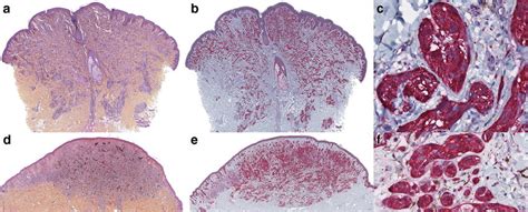 DPN lesions: a pure DPN with deep expansions into the dermis... | Download Scientific Diagram