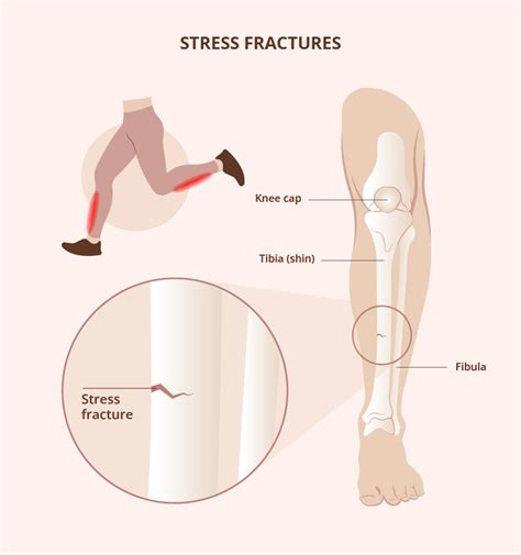 Stress Fractures: Causes, Risks, and Treatment Options | Healthnews