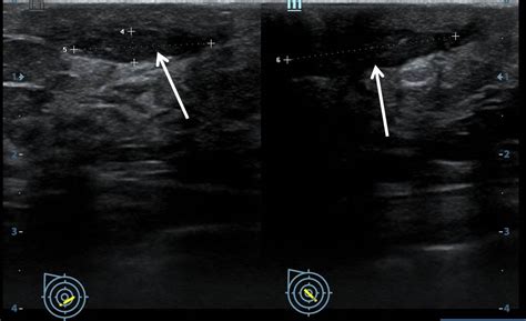 Granulomatous mastitis – Radiology Cases