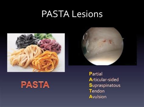 PASTA Lesion and Repair | Hand2Shoulder Clinic