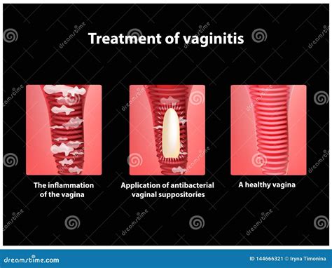 Treatment of Vaginitis Suppositories. Inflammation the Vagina ...