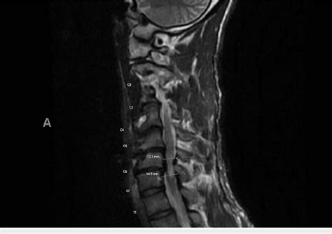 Cervical spine showing myelopathy and myelomalacia from severe spinal ...