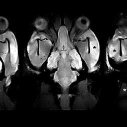 (PDF) Use of MRI for the Early Diagnosis of Masticatory Muscle Myositis