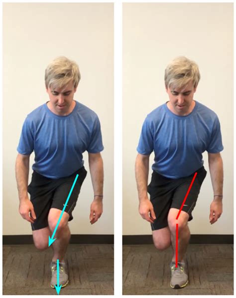 Running: Dynamic Knee Valgus — Precision Physical Therapy