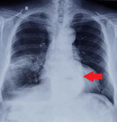 Hiatal Hernia CXR - Sumer's Radiology Blog