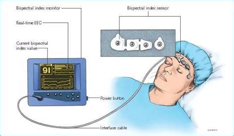 Monitor de Estado de Conciencia del Paciente BIS. INDICE BIESPECTRAL P – MED-TAC International Corp.