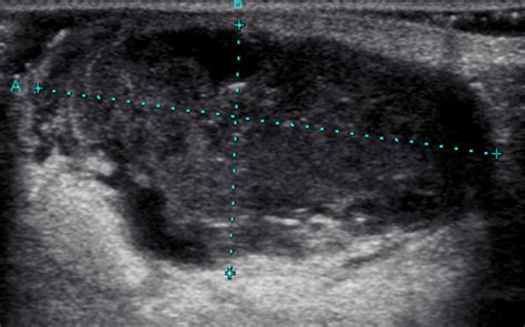 Inflammatory Breast Cancer Ultrasound