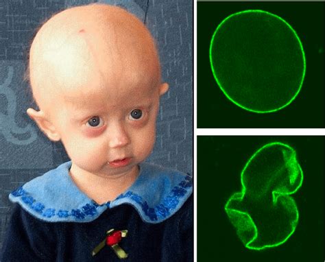 Progeria: Causes, symptoms, and treatment