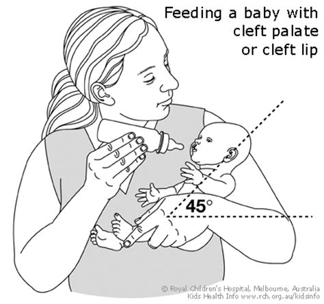 Kids Health Info : Cleft lip and palate infant feeding