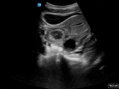 Tubo Ovarian Abscess On Ultrasound