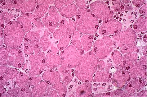 Pancreatic Cancer Samples - Lab-Ally