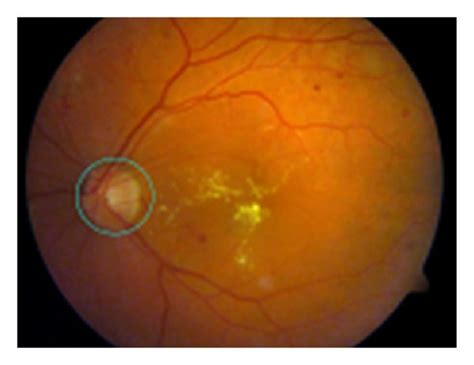 The detection of the optic disc | Download Scientific Diagram