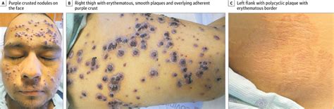 Purple Crusted Nodules in a Patient With End-stage Liver Disease | Dermatology | JAMA ...