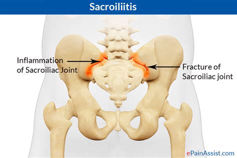 sacroiliac3 — Back to Health Wellness Centre