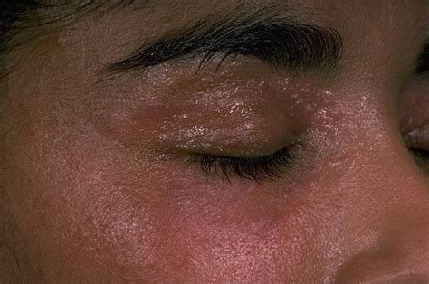 Clues to Rosacea in Patients of Skin of Color • Aerolase