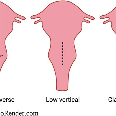 Types of cesarean section surgical incisions. Diagram depicts several ...