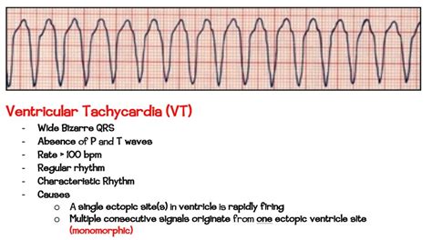 EKG & Dysrhythmia Interpretation - Etsy