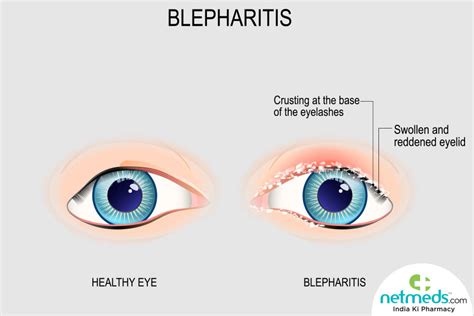 Blepharitis: Causes, Symptoms And Treatment | Netmeds