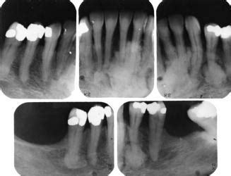 Cementoma