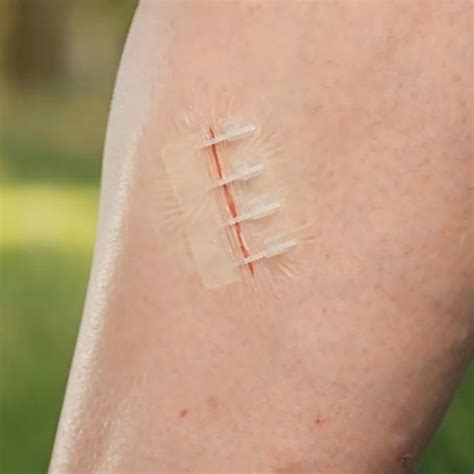 Zip Stitch | Easy Wound Closure Strips | No-More Stitches and Laceration Kit | TheSuperBOO!