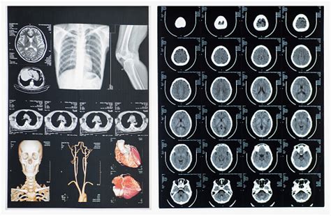 Head Ct Scanning Film Stock Photo - Download Image Now - iStock