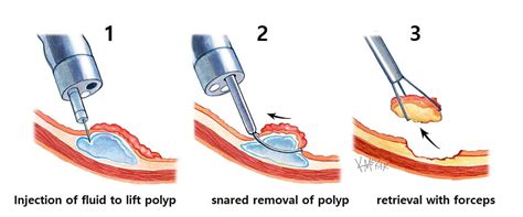 Polyps | Colorectal Surgeons Sydney