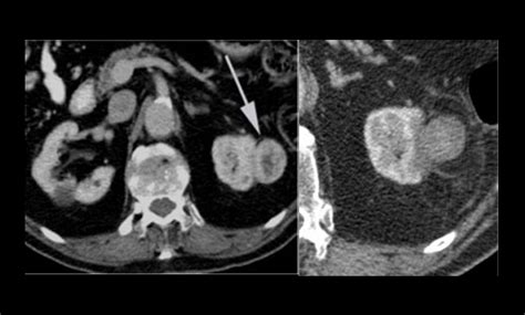 Radiofrequency/Microwave Ablation for Treating Kidney Tumors