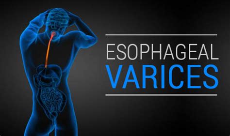 Esophageal Varices - The Wellness Corner