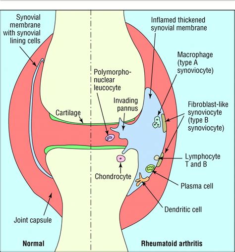 Science, medicine, and the future: Treatment of rheumatoid arthritis | The BMJ