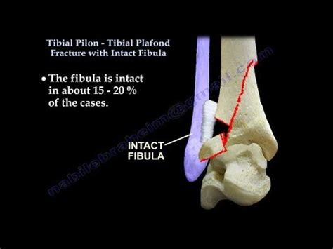 Tibial Pilon Fracture With Intact Fibula - Everything You Need To Know - Dr. Nabil Ebraheim ...
