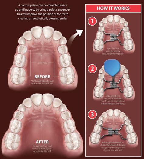 Palatal Expander - Macau Dentist : Macau Dentist