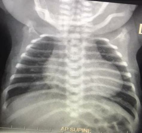 Chest X-ray showing cardiomegaly with 'egg-on-a-string' shape feature ...