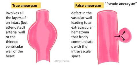 Aneurysms: Types, Causes, and Management - Pathology Made Simple