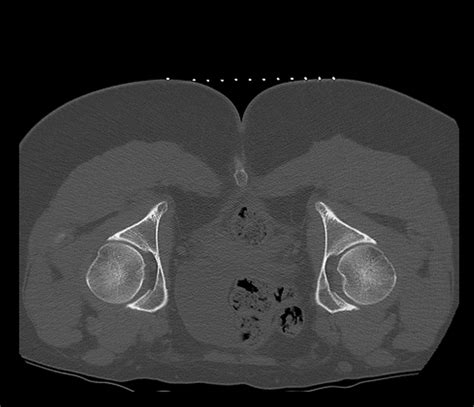 Bilateral Pudendal Nerve Block