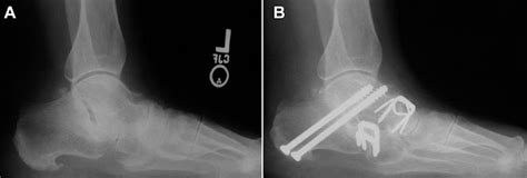 Triple Arthrodesis - My Path to Recovery: Introduction