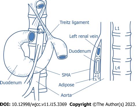 Superior mesenteric artery syndrome: Diagnosis and management