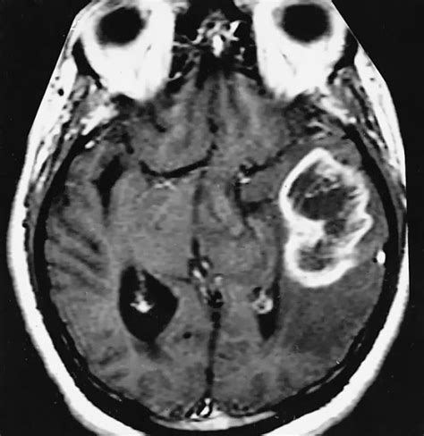 Differential diagnoses of ring enhancing lesions | The Internist :: Medikal Notes