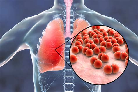 Bullous Lung Disease or Bullous Emphysema? A Detailed Overview