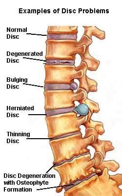 How To Cure Lumbar Spondylosis - Apartmentairline8