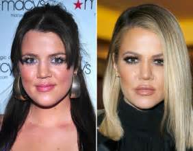 Khloe Kardashian face change | Celebrity Face Transformations | Celebrity Galleries | Pics ...