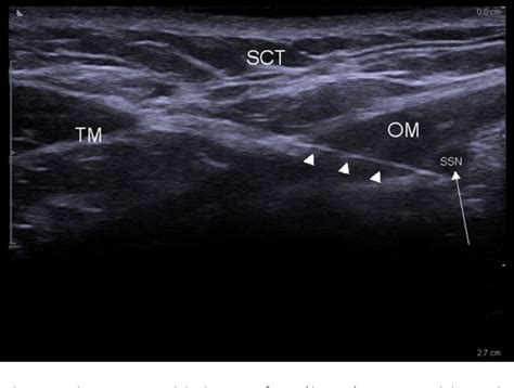 Figure 3 from Ultrasound-guided block of the suprascapular nerve - a volunteer study of a new ...