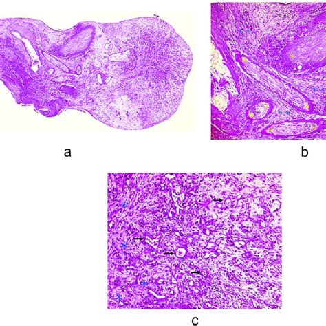 (PDF) Excision of recurrent appendix testis torsion