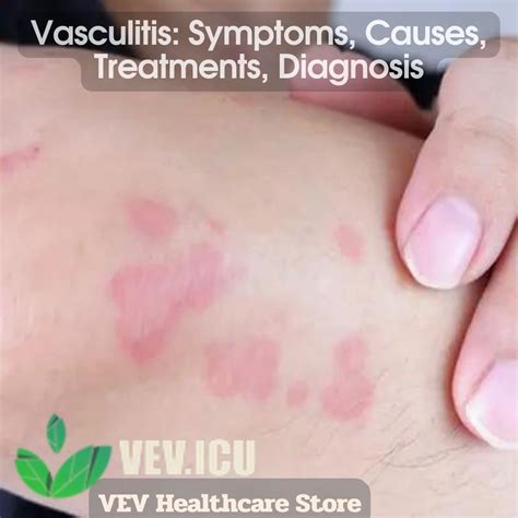 Vasculitis: Symptoms, Causes, Treatments, Diagnosis