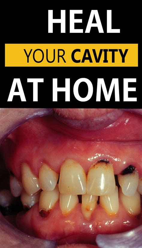 How To Heal a Cavity Without Fillings - A Fit Life Style | Tooth decay remedies, Heal cavities ...