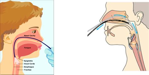 Visuals: Assessment/Intervention - Vocal Nodules