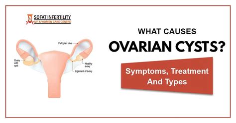 What is Ovarian Cyst? Causes, Symptoms, Treatment, Types – Dr. Sumita ...