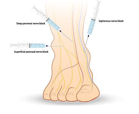 Lower Extremity Nerve Block Ankle Front View Regional Anesthesia Ilustration Needle Placement ...