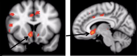 The Brain in Recovery – Recovery Research Institute