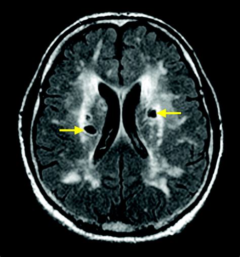 Leukoaraiosis | Practical Neurology