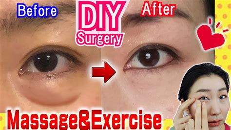 How to Remove Under Eye Bags👁️ Naturally in 7 Days Massage & Exercises🙋 ...